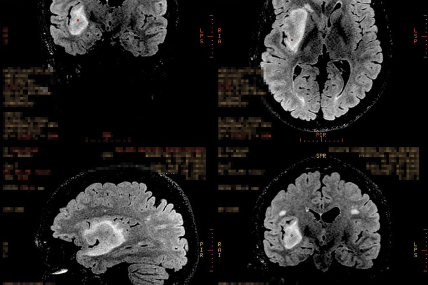 A mancha branca é (era) o tumor em formato de elipse.