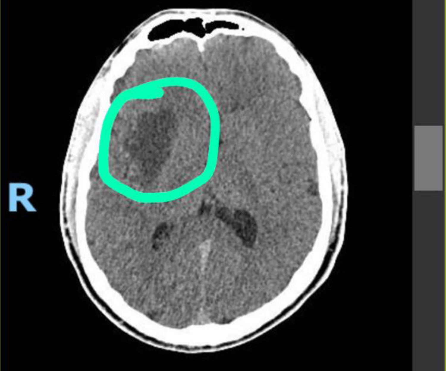 Mancha na Tomografia, indicada pelo amigo Rodrigo Lanna.