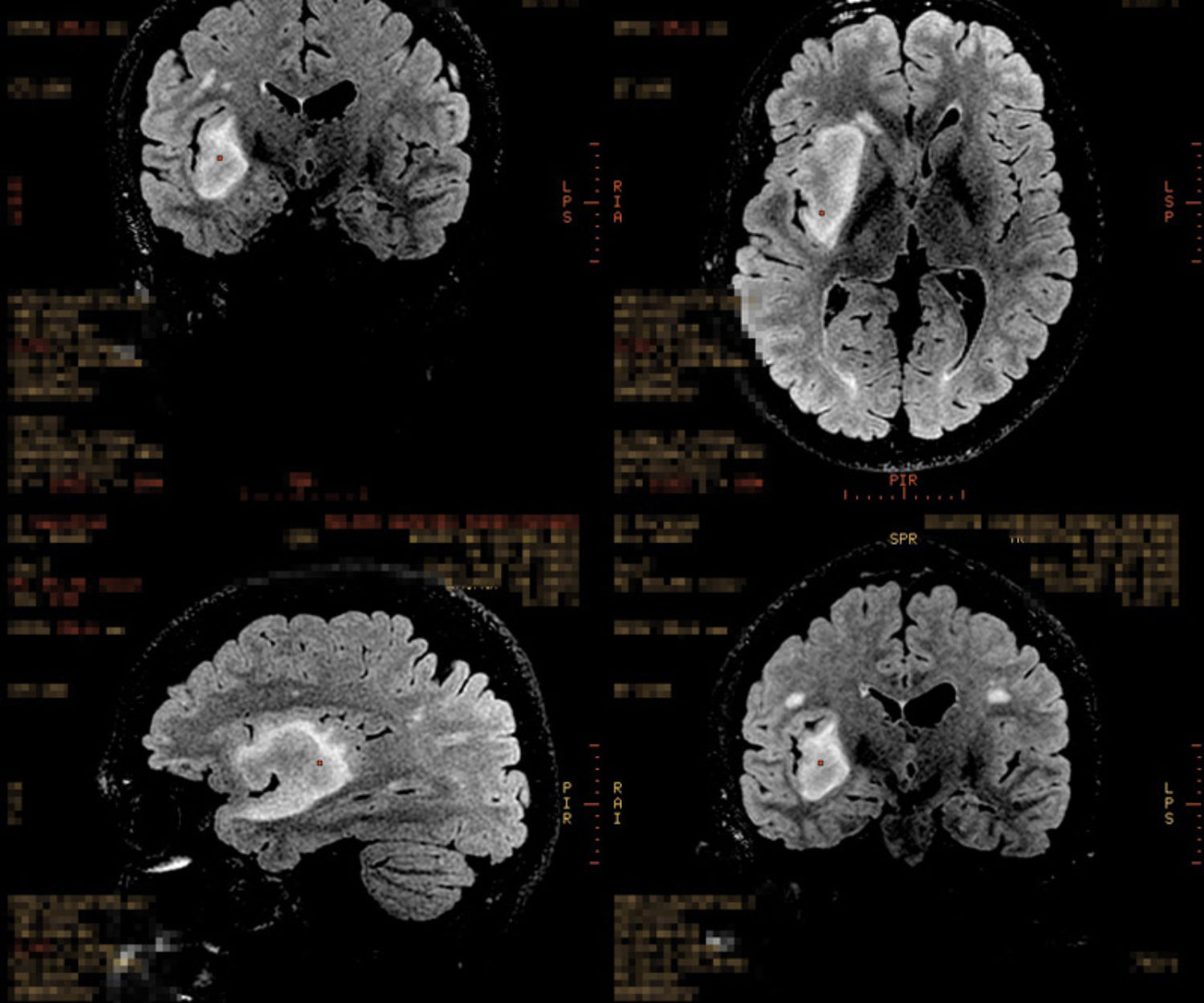 A mancha branca é (era) o tumor em formato de elipse.
